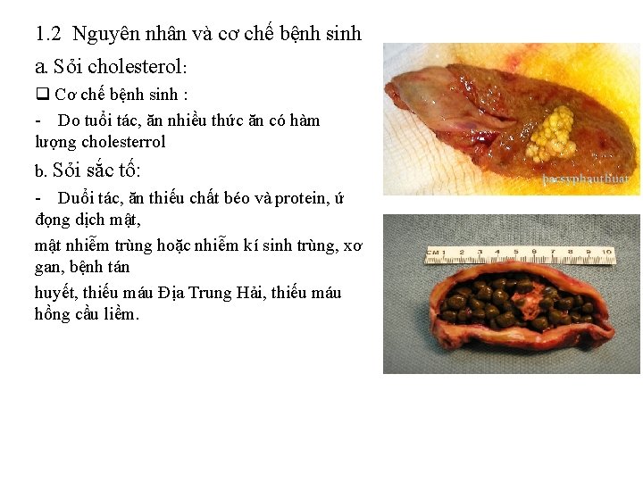 1. 2 Nguyên nhân và cơ chế bệnh sinh a. Sỏi cholesterol: q Cơ