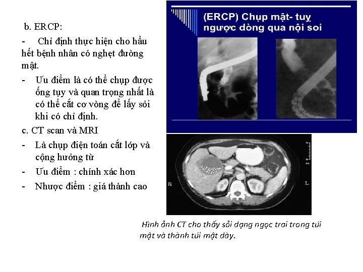 b. ERCP: - Chỉ định thực hiện cho hầu hết bệnh nhân có nghẹt