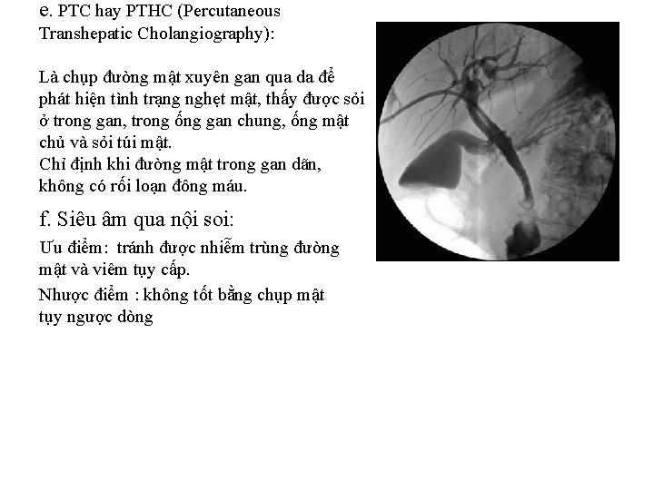 e. PTC hay PTHC (Percutaneous Transhepatic Cholangiography): Là chụp đường mật xuyên gan qua