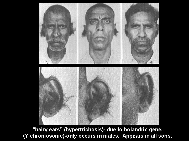 “hairy ears” (hypertrichosis)- due to holandric gene. (Y chromosome)-only occurs in males. Appears in