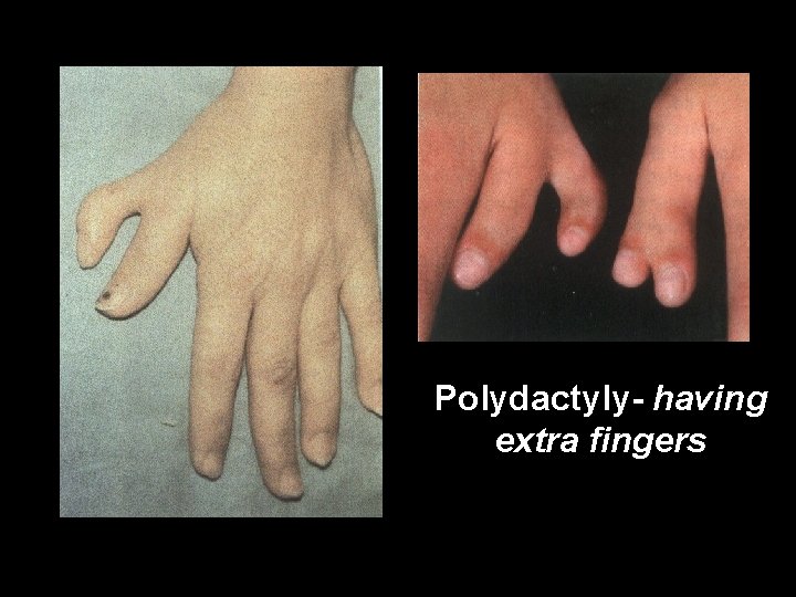 Polydactyly- having extra fingers 