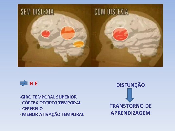 HE -GIRO TEMPORAL SUPERIOR - CÓRTEX OCCIPTO TEMPORAL - CEREBELO - MENOR ATIVAÇÃO TEMPORAL