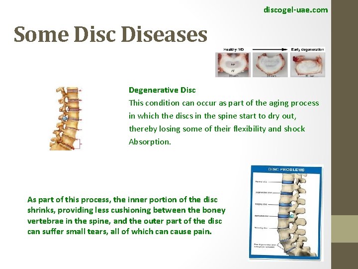 discogel-uae. com Some Disc Diseases Degenerative Disc This condition can occur as part of