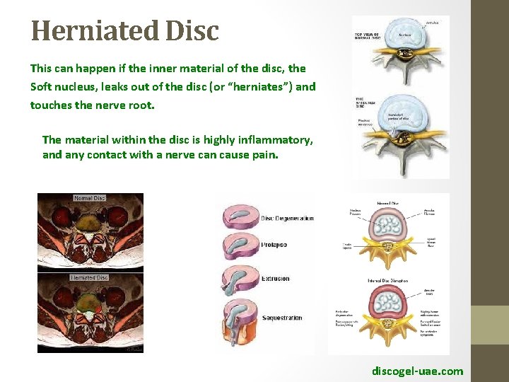 Herniated Disc This can happen if the inner material of the disc, the Soft