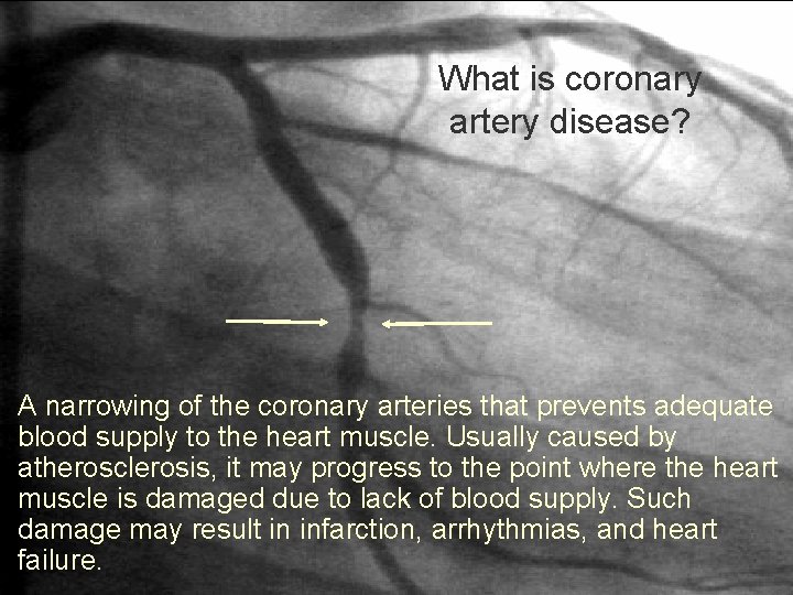 What is coronary artery disease? A narrowing of the coronary arteries that prevents adequate
