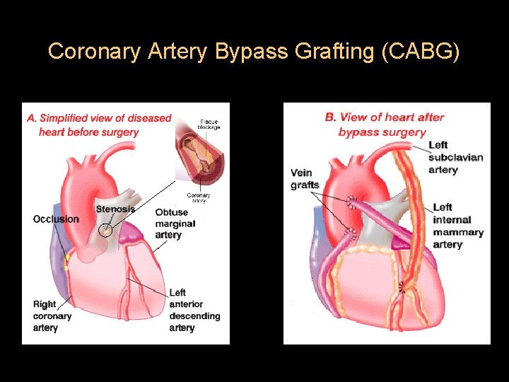 Coronary Artery Bypass Grafting (CABG) 