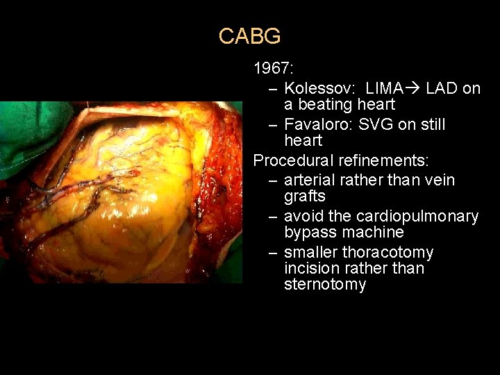 CABG 1967: – Kolessov: LIMA LAD on a beating heart – Favaloro: SVG on