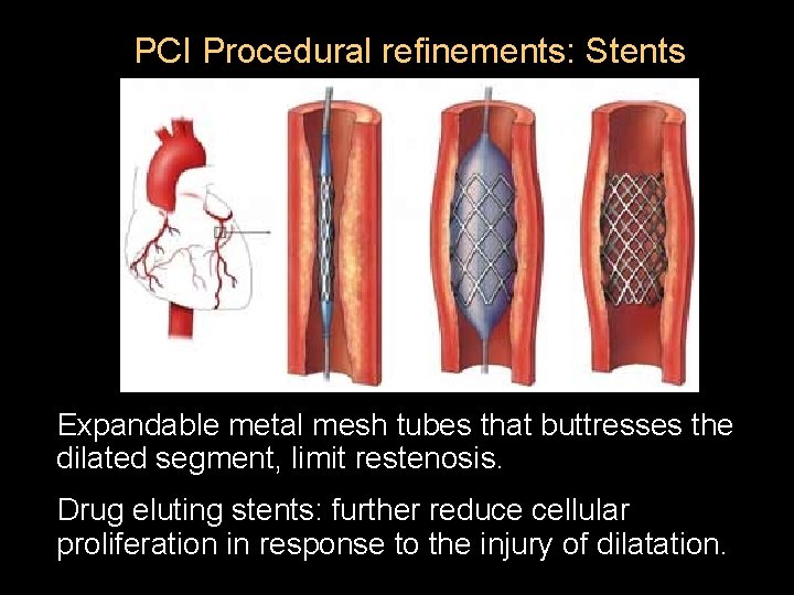 PCI Procedural refinements: Stents Expandable metal mesh tubes that buttresses the dilated segment, limit