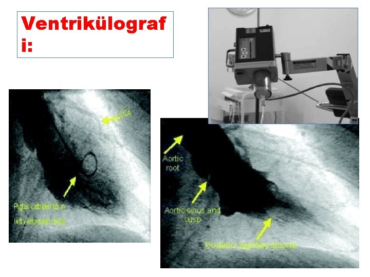 Ventrikülograf i: 