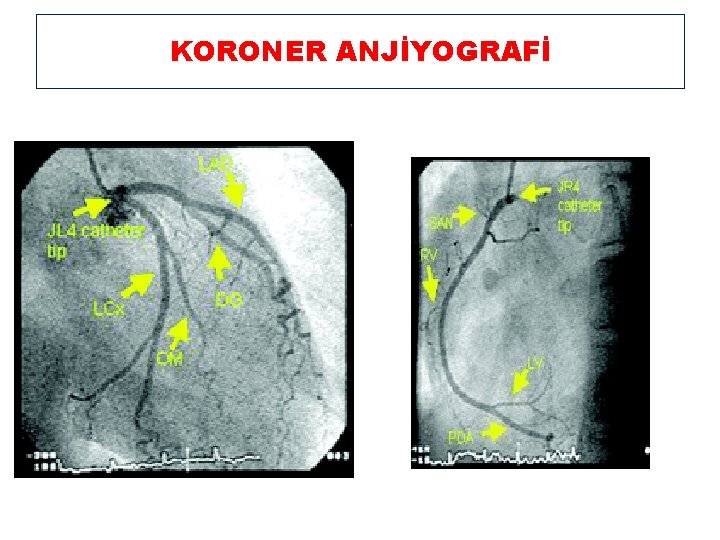 KORONER ANJİYOGRAFİ 