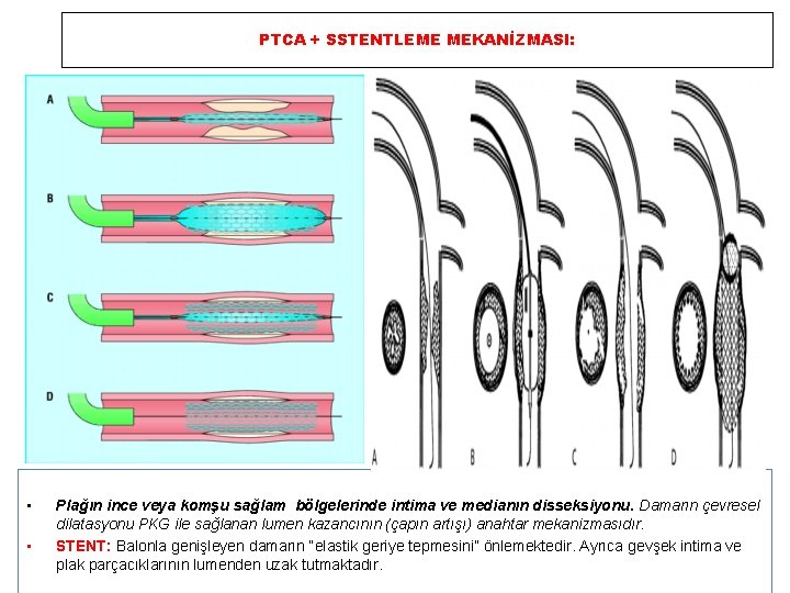 PTCA + SSTENTLEME MEKANİZMASI: • • Plağın ince veya komşu sağlam bölgelerinde intima ve