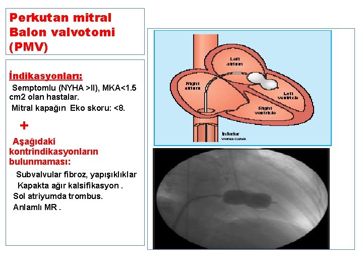 Perkutan mitral Balon valvotomi (PMV) İndikasyonları: • Semptomlu (NYHA >II), MKA<1. 5 cm 2