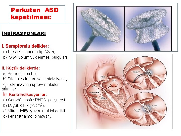Perkutan ASD kapatılması: İNDİKASYONLAR: i. Semptomlu delikler: • a) PFO (Sekundum tip ASD), •