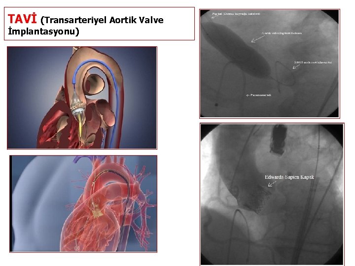 TAVİ (Transarteriyel Aortik Valve İmplantasyonu) 