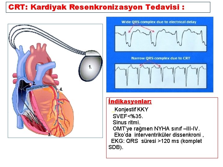 CRT: Kardiyak Resenkronizasyon Tedavisi : İndikasyonlar: § Konjestif KKY § SVEF<%35. § Sinus ritmi.