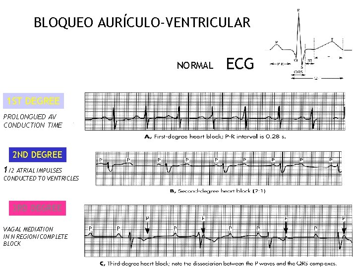 BLOQUEO AURÍCULO-VENTRICULAR NORMAL 1 ST DEGREE PROLONGUED AV CONDUCTION TIME 2 ND DEGREE 1/2