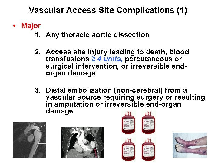 Vascular Access Site Complications (1) • Major 1. Any thoracic aortic dissection 2. Access Vascular Access Site Complications (1) • Major 1. Any thoracic aortic dissection 2. Access