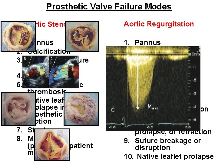 Prosthetic Valve Failure Modes Aortic Stenosis 1. Pannus 2. Calcification 3. Support structure deformation Prosthetic Valve Failure Modes Aortic Stenosis 1. Pannus 2. Calcification 3. Support structure deformation