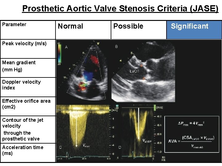 Prosthetic Aortic Valve Stenosis Criteria (JASE) Parameter Normal Possible Significant Peak velocity (m/s) <3 Prosthetic Aortic Valve Stenosis Criteria (JASE) Parameter Normal Possible Significant Peak velocity (m/s) <3