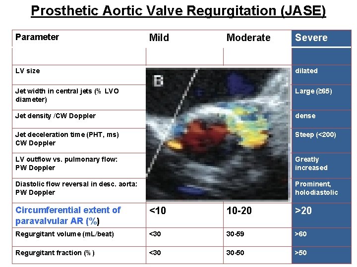 Prosthetic Aortic Valve Regurgitation (JASE) Parameter Mild Moderate Severe LV size Normal/mildly dilated Jet Prosthetic Aortic Valve Regurgitation (JASE) Parameter Mild Moderate Severe LV size Normal/mildly dilated Jet