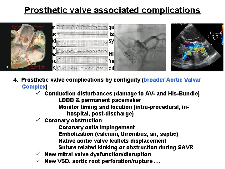 Prosthetic valve associated complications 1. Paravalvular prosthetic aortic regurgitation 2. Prosthetic aortic valve thrombosis Prosthetic valve associated complications 1. Paravalvular prosthetic aortic regurgitation 2. Prosthetic aortic valve thrombosis