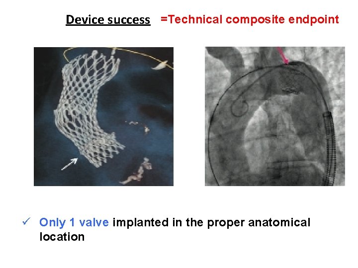 Device success =Technical composite endpoint ü Successful vascular access, delivery, device deployment and delivery Device success =Technical composite endpoint ü Successful vascular access, delivery, device deployment and delivery