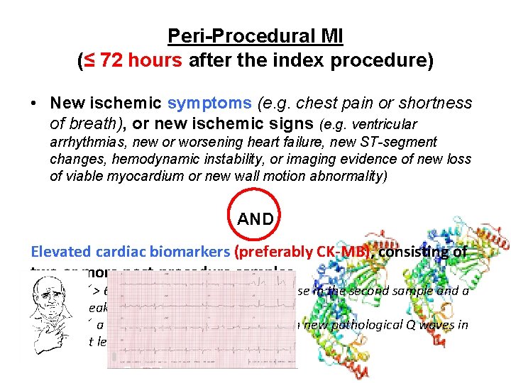 Peri-Procedural MI (≤ 72 hours after the index procedure) • New ischemic symptoms (e. Peri-Procedural MI (≤ 72 hours after the index procedure) • New ischemic symptoms (e.