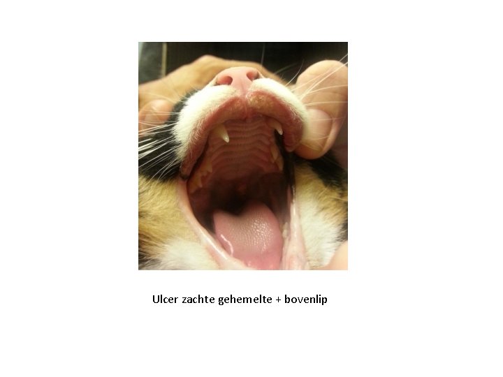Ulcer zachte gehemelte + bovenlip 