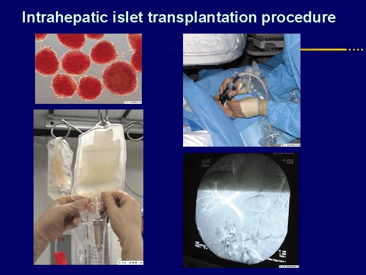 Intrahepatic islet transplantation procedure 