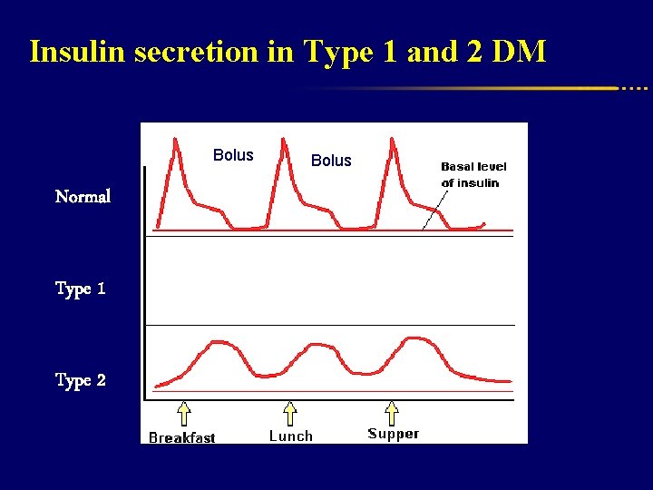 Insulin secretion in Type 1 and 2 DM Prandial Bolus Normal Type 1 Type