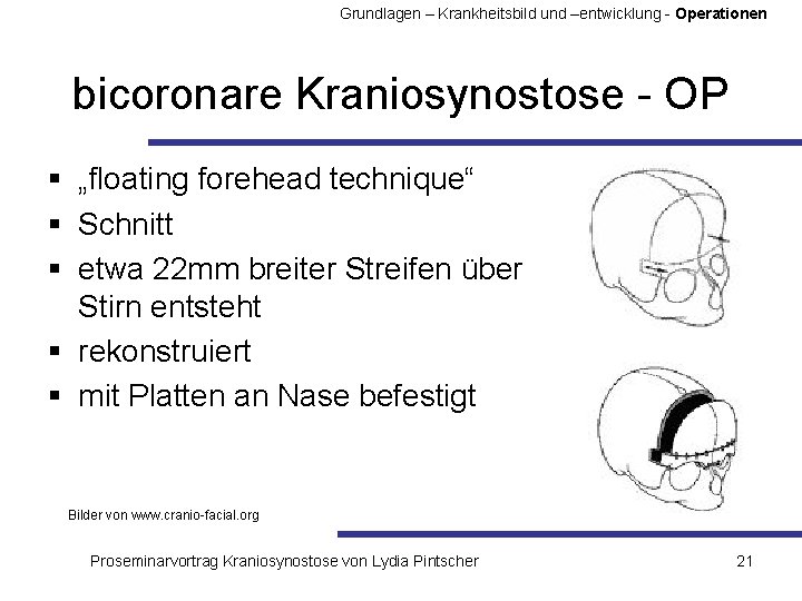 Grundlagen – Krankheitsbild und –entwicklung - Operationen bicoronare Kraniosynostose - OP § „floating forehead