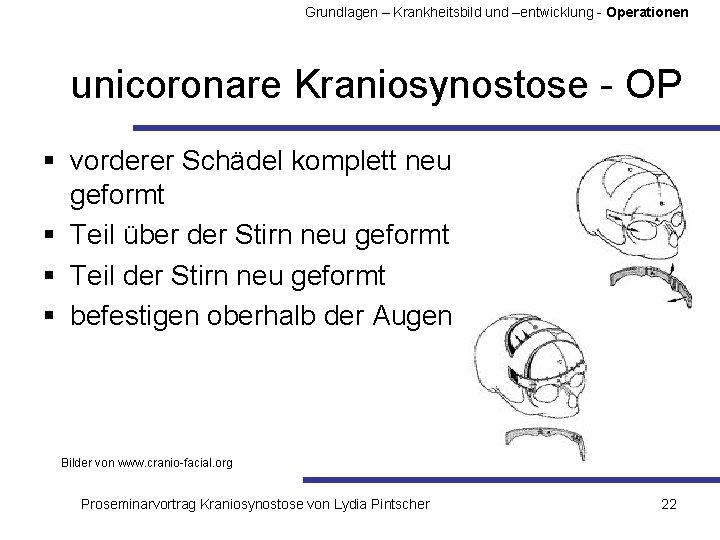 Grundlagen – Krankheitsbild und –entwicklung - Operationen unicoronare Kraniosynostose - OP § vorderer Schädel