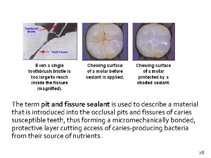 The term pit and fissure sealant is used to describe a material that is