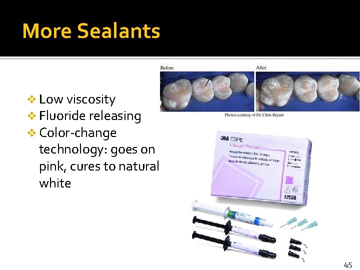 More Sealants v Low viscosity v Fluoride releasing v Color-change technology: goes on pink,