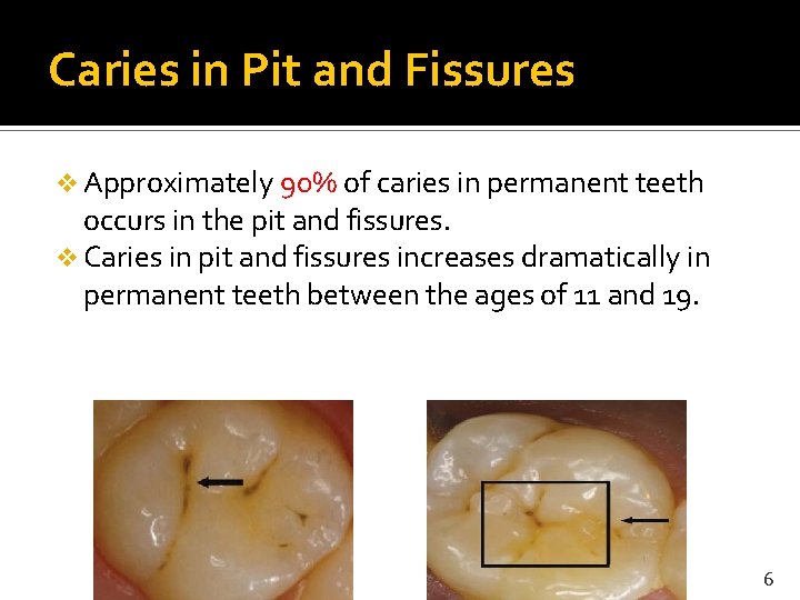 Caries in Pit and Fissures v Approximately 90% of caries in permanent teeth occurs