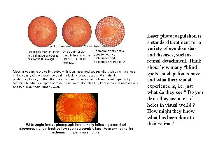 Laser photocoagulation is a standard treatment for a variety of eye disorders and diseases,