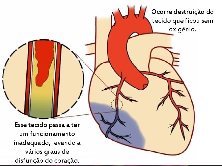 Ocorre destruição do tecido que ficou sem oxigênio. É quando ocorre o “entupimento” de