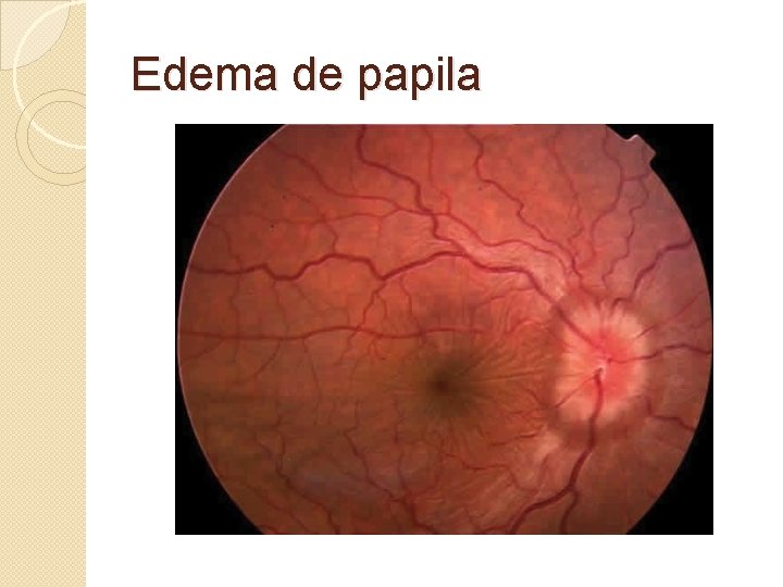 Edema de papila Edema de papila