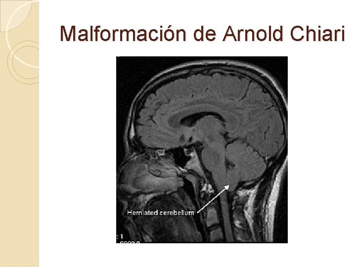 Malformación de Arnold Chiari Malformación de Arnold Chiari