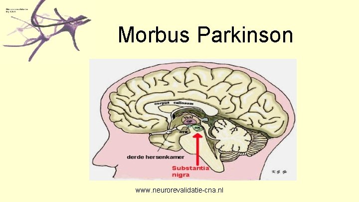 Morbus Parkinson www. neurorevalidatie-cna. nl 