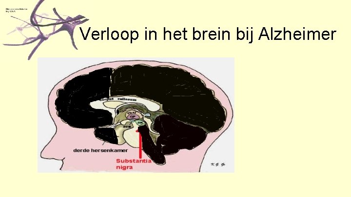 Verloop in het brein bij Alzheimer 