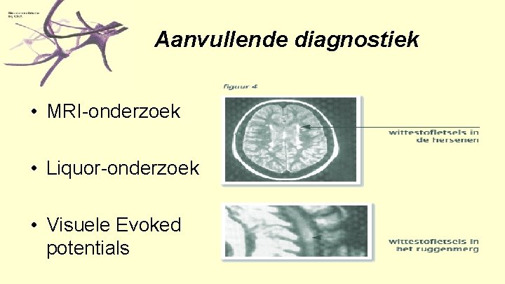 Aanvullende diagnostiek • MRI-onderzoek • Liquor-onderzoek • Visuele Evoked potentials 