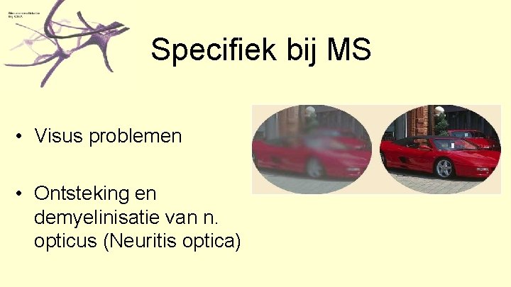 Specifiek bij MS • Visus problemen • Ontsteking en demyelinisatie van n. opticus (Neuritis