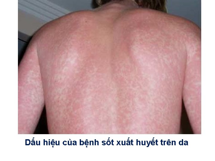 Dấu hiệu của bệnh sốt xuất huyết trên da 