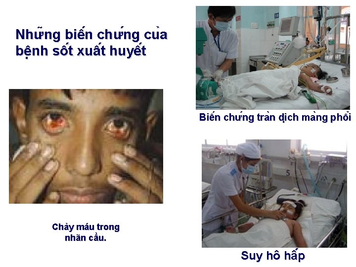 Như ng biê n chư ng cu a bê nh sô t xuâ t