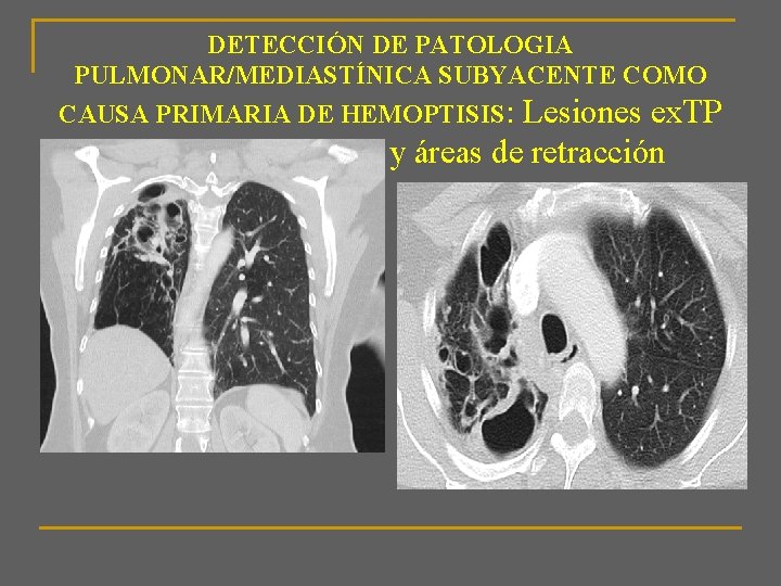 DETECCIÓN DE PATOLOGIA PULMONAR/MEDIASTÍNICA SUBYACENTE COMO CAUSA PRIMARIA DE HEMOPTISIS: Lesiones ex. TP con