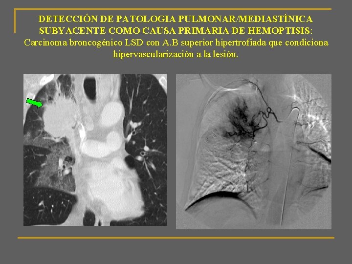 DETECCIÓN DE PATOLOGIA PULMONAR/MEDIASTÍNICA SUBYACENTE COMO CAUSA PRIMARIA DE HEMOPTISIS: Carcinoma broncogénico LSD con