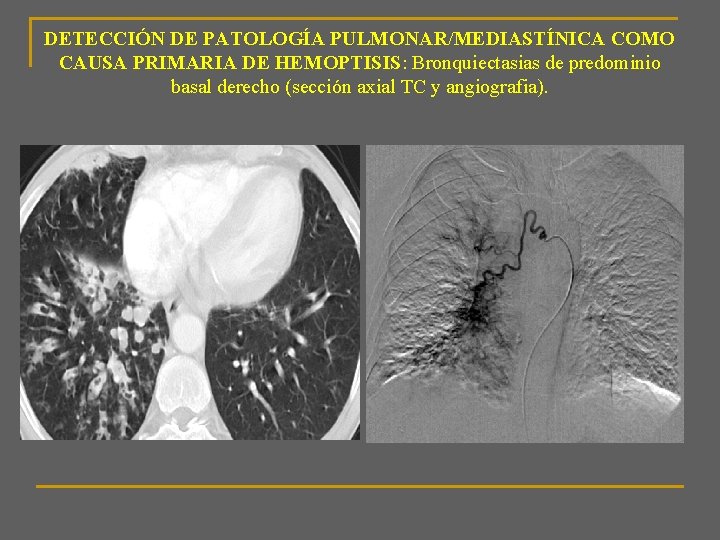 DETECCIÓN DE PATOLOGÍA PULMONAR/MEDIASTÍNICA COMO CAUSA PRIMARIA DE HEMOPTISIS: Bronquiectasias de predominio basal derecho