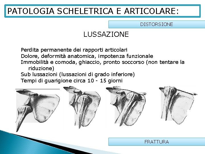 PATOLOGIA SCHELETRICA E ARTICOLARE: DISTORSIONE LUSSAZIONE Perdita permanente dei rapporti articolari Dolore, deformità anatomica,