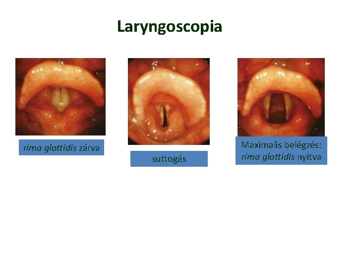 Laryngoscopia rima glottidis zárva suttogás Maximalis belégzés: rima glottidis nyitva Laryngoscopia rima glottidis zárva suttogás Maximalis belégzés: rima glottidis nyitva